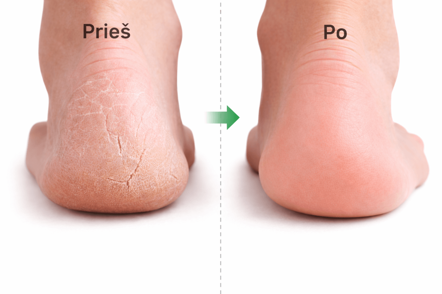 Kulnų „Prieš“ ir „Po“ palyginimas: kairėje - sausas, suskilęs kulnas su suragėjusia oda ir įtrūkimais, dešinėje - lygesnis, minkštesnis kulnas. Pėdų priežiūra namuose, kulnų šveitimas ir drėkinimas, pedikiūro rutina sausai odai.