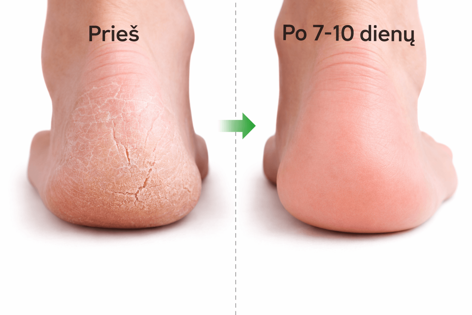 Kulnų „prieš ir po“ palyginimas - kairėje suskilinėję, sausi, suragėję kulnai („Prieš“), dešinėje lygesnė, minkštesnė oda po 7–10 dienų („Po 7–10 dienų“). Pėdų priežiūros rutina namuose, skirta šiurkščiai odai, nuospaudoms ir kulnų skilinėjimui mažinti, geresniam drėkinimui ir komfortui.