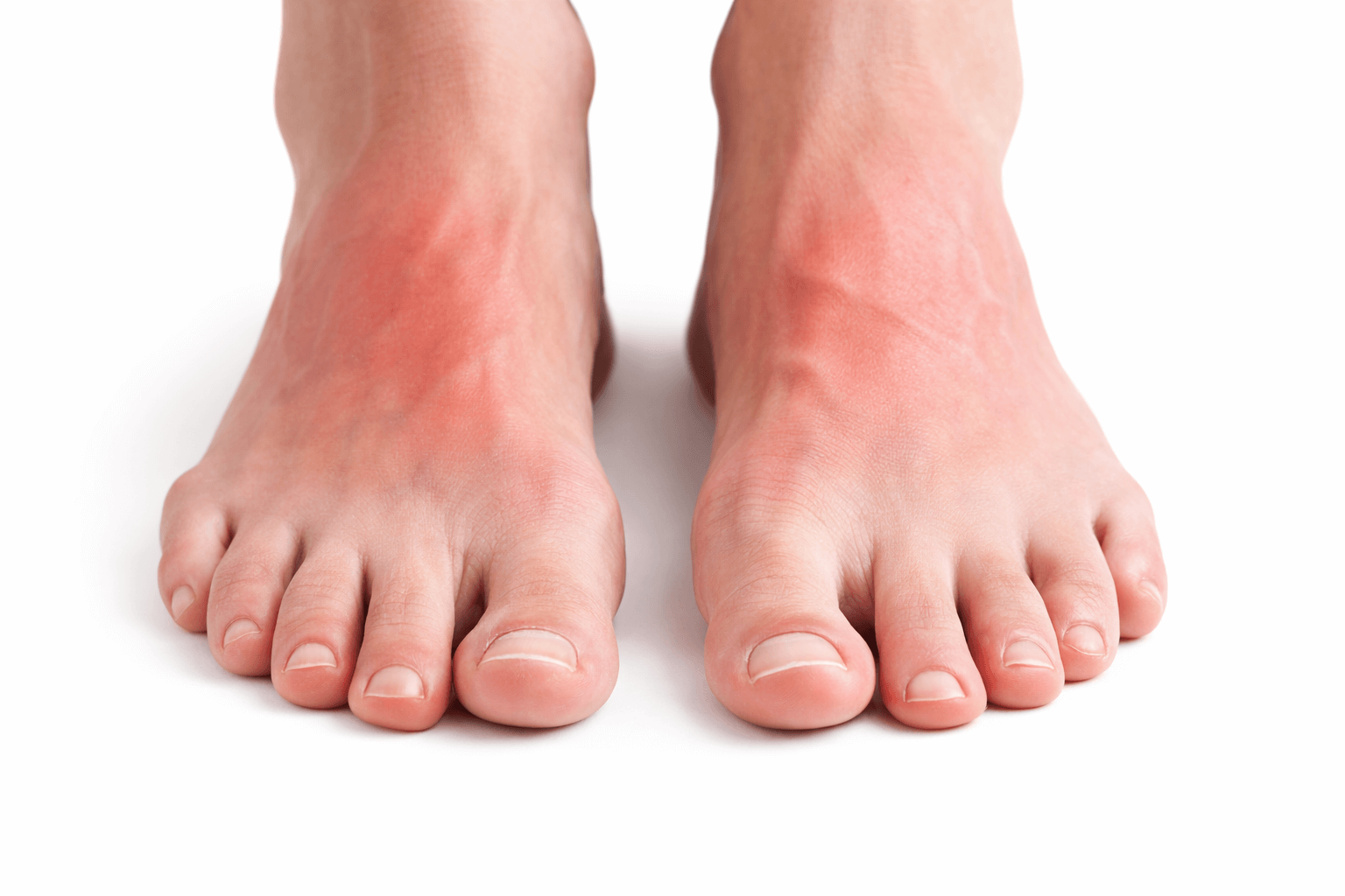 Pėdos iš priekio su paraudimu ties pėdos viršumi - pavargusios, sudirgusios pėdos po ilgos dienos; pėdų priežiūra namuose, atgaiva ir komfortas, minkštinimas, drėkinimas, priemonės nuo sausumo ir diskomforto (kremas, pėdų kaukė, švelnus ritualas).